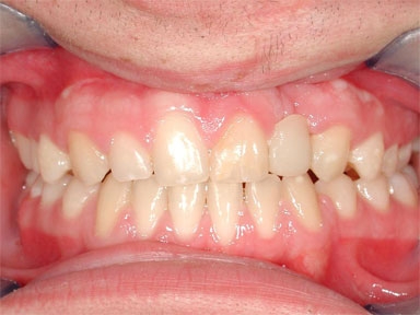 implantologia dentale-civitanova marche
