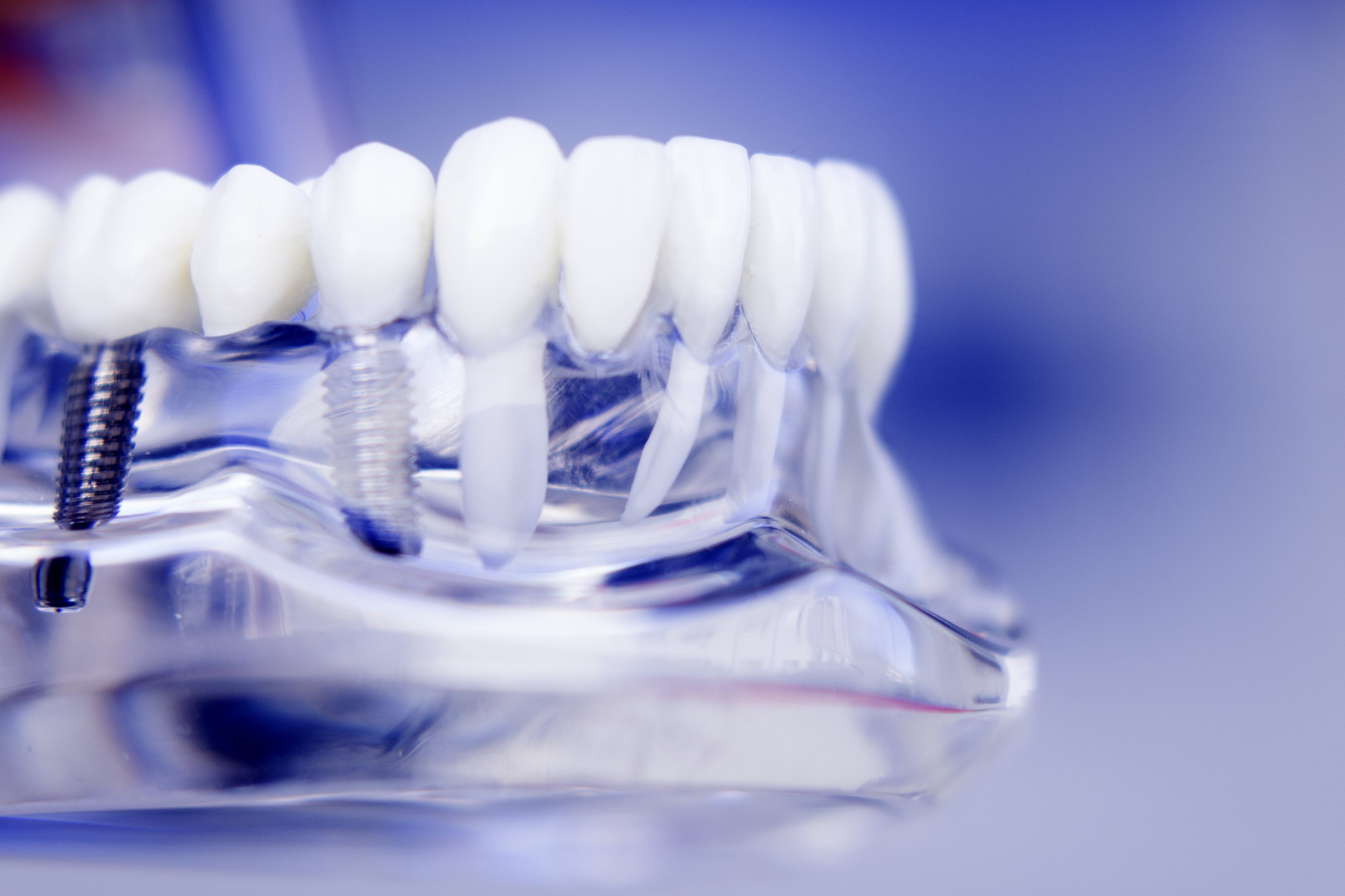 Cosa significa implantologia a carico immediato? | Dentista Macerata